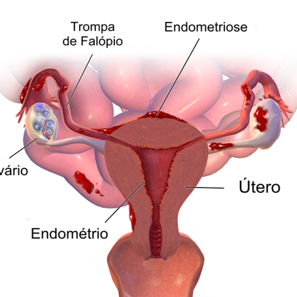endometriose3