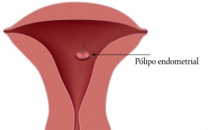 polipo_endometrial2